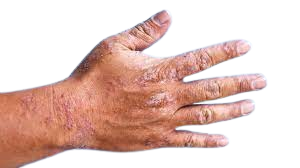 Cracked, very dry or healing skin